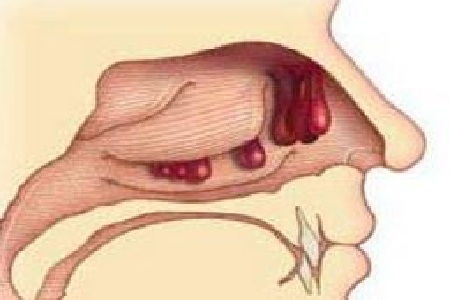 苟伟死因曝光 鼻息肉肥大致呼吸骤停